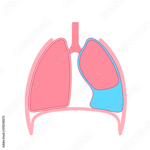 Pleural effusion poster