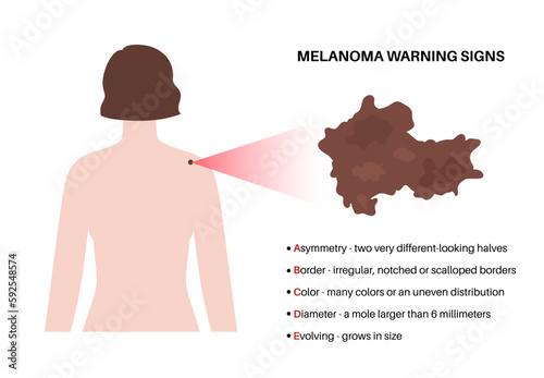 Melanoma warning signs