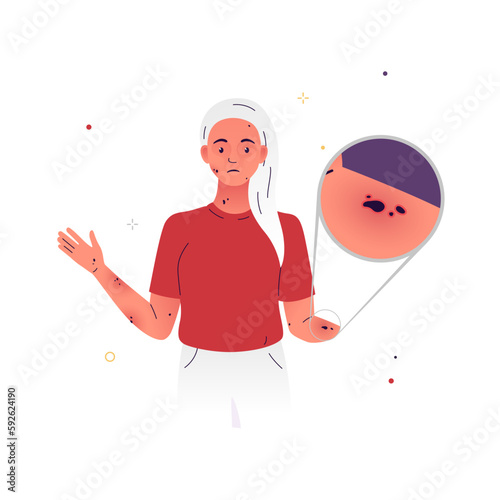 Vector illustration of a character with moles all over his body. The woman has moles on her body, they are of unusual size and texture. Symptoms of hormonal imbalance, infection in the body, cancer