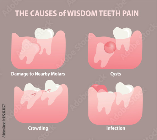 the causes of Wisdom tooth pain illustration