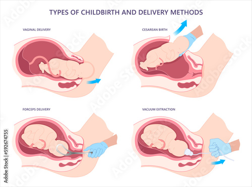 Fetal Childbirth Cesarean C Section the procedure in medical Occiput Anterior Delivery to pull baby from uterus facial palsy and scalp edema pain Forceps Assisted Vacuum Vaginal labor photo