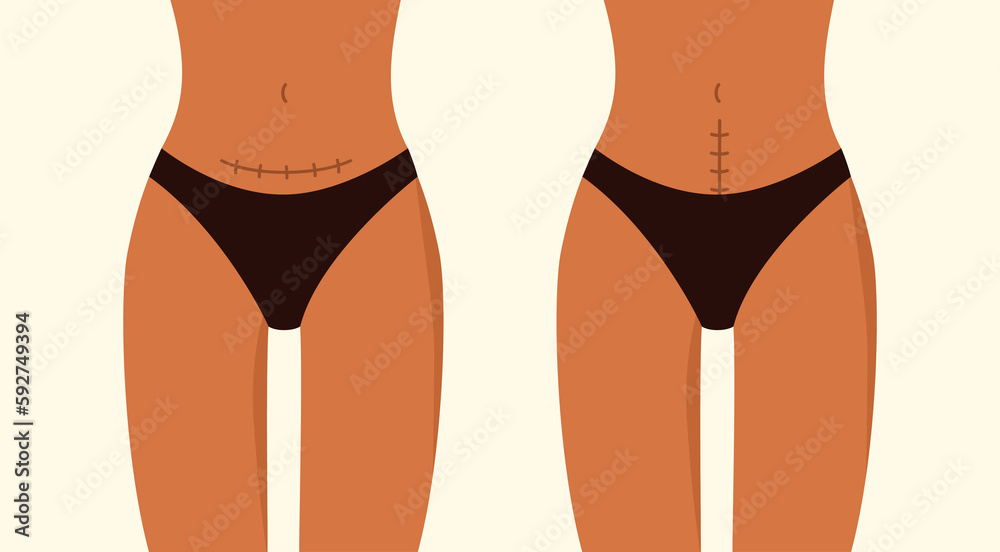 Vertical and horizontal cesarean scar. Stitches after caesarean section on female belly. C-section, surgical delivery operation concept. Vector illustration in cartoon style. Isolated white background Vertical and horizontal cesarean scar. Stitches after caesarean section on female belly. C-section, surgical delivery operation concept. Vector illustration in cartoon style. Isolated white background