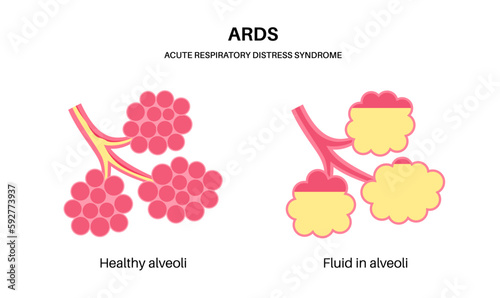 ARDS anatomical poster