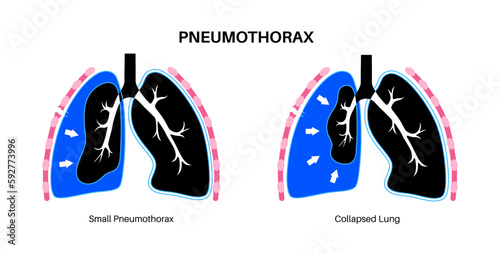 Pneumothorax anatomical poster