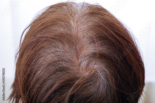 高齢女性の薄毛と白髪の頭頂部