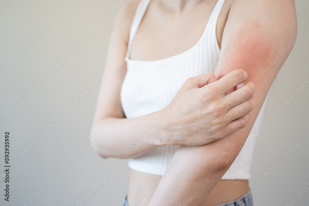 Sensitive skin allergic concept, Woman itching on her arm have a red rash from allergy symptom and from scratching. - obrazy, fototapety, plakaty 