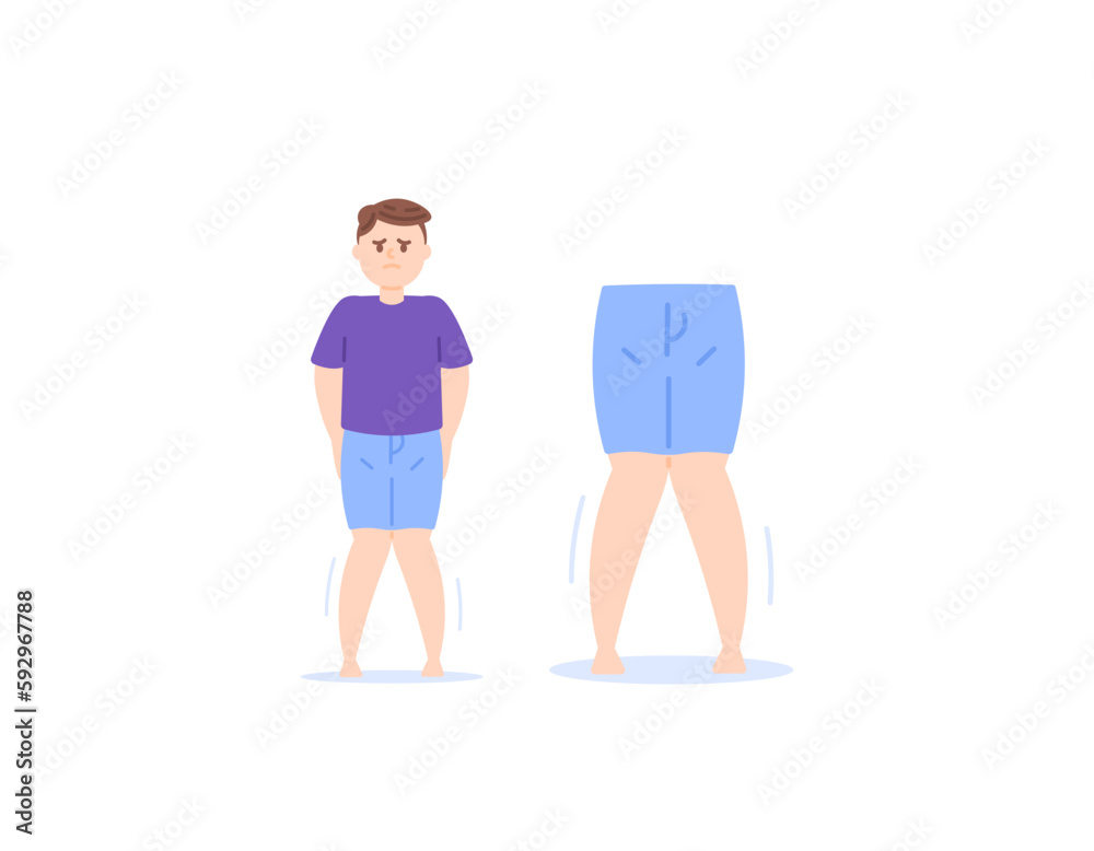 Knock knee, Rickets, genu valgum. bone growth abnormalities. a man ...