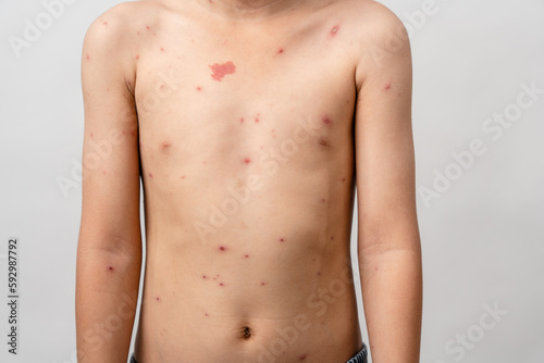 A 7 year old Asian boy has chickenpox. pimples on the body of child with chickenpox