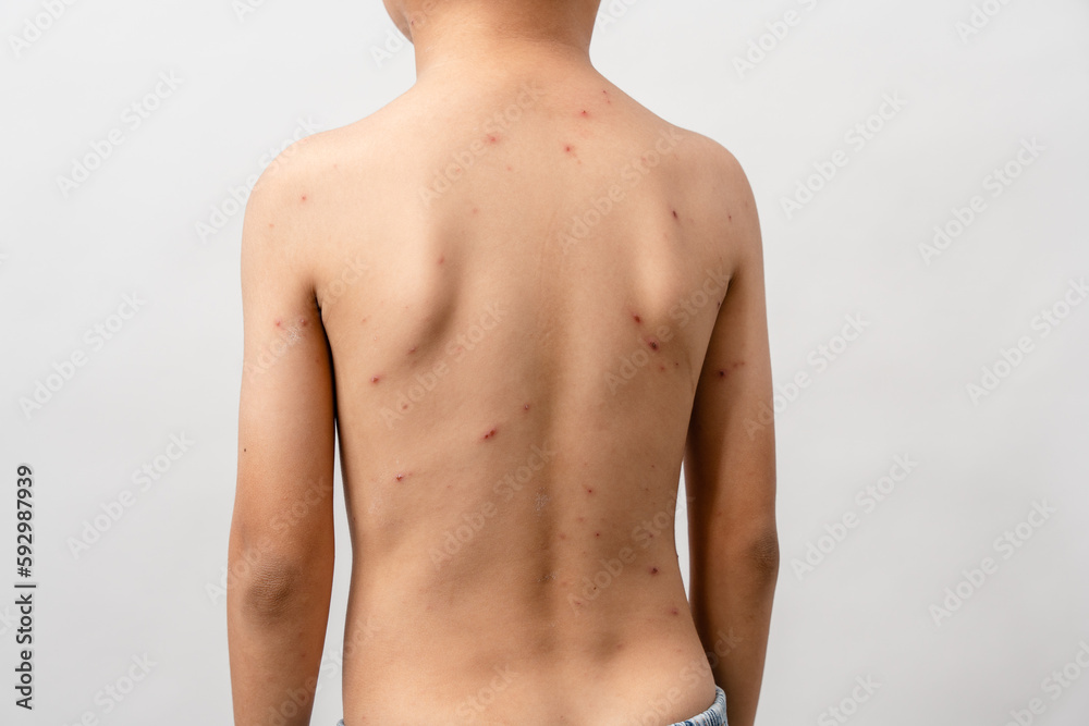 A 7 year old Asian boy has chickenpox. pimples on the body of child with chickenpox A 7 year old Asian boy has chickenpox. pimples on the body of child with chickenpox