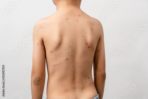 Εκτύπωση καμβά A 7 year old Asian boy has chickenpox