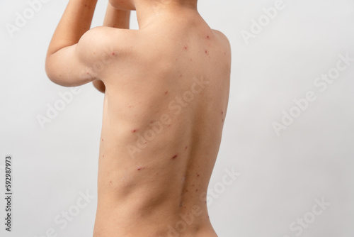 Φωτογραφία A 7 year old Asian boy has chickenpox
