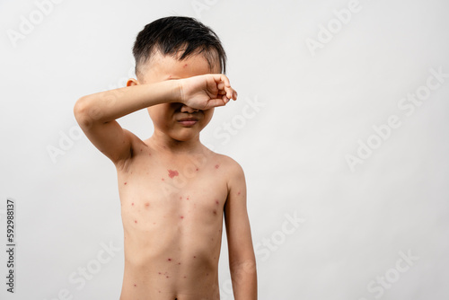 Εκτύπωση καμβά A 7 year old Asian boy has chickenpox