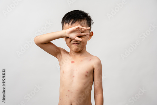 Εκτύπωση καμβά A 7 year old Asian boy has chickenpox