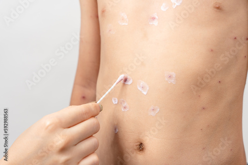 A mother is applying itching ointment to him 7 year old Asian boy suffering from chickenpox. pimples on the body of child with chickenpox
