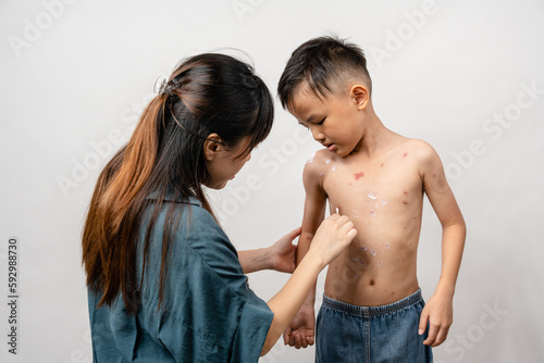 Φωτογραφία A mother is applying itching ointment to him 7 year old Asian boy suffering from chickenpox