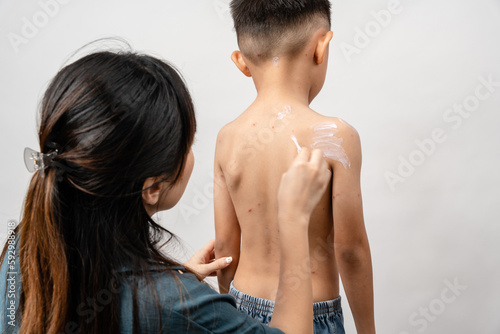 Obraz na plátne A mother is applying itching ointment to him 7 year old Asian boy suffering from chickenpox