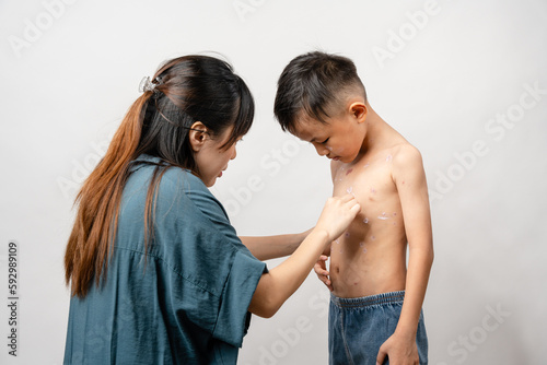 Foto A mother is applying itching ointment to him 7 year old Asian boy suffering from chickenpox