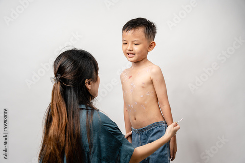 Obraz na plátně A mother is applying itching ointment to him 7 year old Asian boy suffering from chickenpox