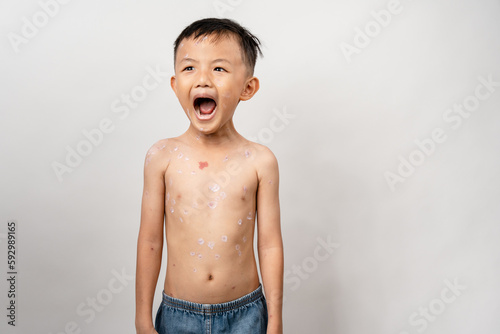 Obraz na plátně A 7 year old Asian boy has chickenpox