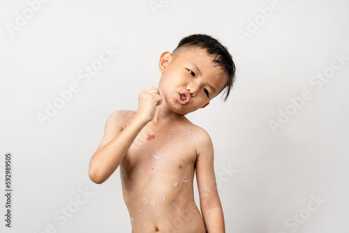 Εκτύπωση καμβά A 7 year old Asian boy has chickenpox