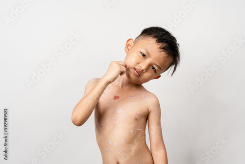 Εκτύπωση καμβά A 7 year old Asian boy has chickenpox