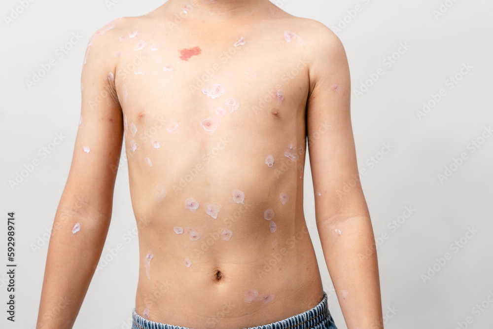 A 7 year old Asian boy has chickenpox. pimples on the body of child with chickenpox A 7 year old Asian boy has chickenpox. pimples on the body of child with chickenpox