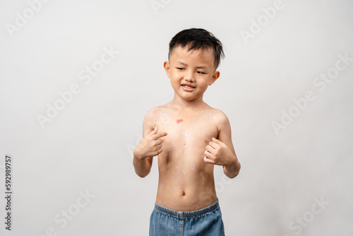 Fotografie A 7 year old Asian boy has chickenpox