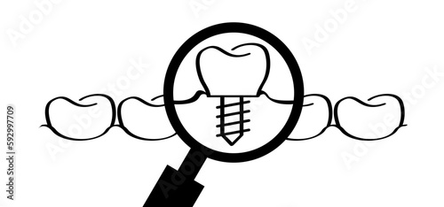 Dental implant, medically accurate or dental bridge. Cartoon healthy, tooth with gums. Molar line pattern. Drawing tooth with screw. Damage teeth or tooth with caries. Surgery jaw, medicine screw.
