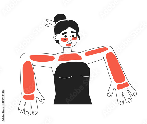 Young woman with severe sunburns monochromatic flat vector character. Sun poisoning. Editable thin line half body person on white. Simple bw cartoon spot image for web graphic design, animation