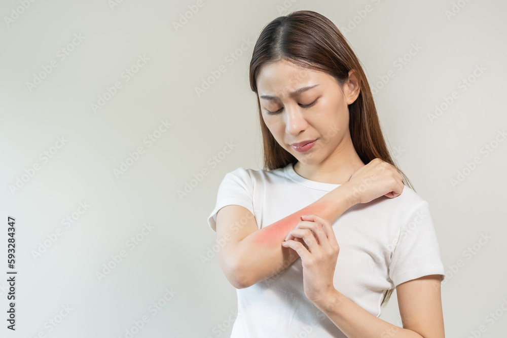 Dermatology asian young woman, girl allergy, allergic reaction from atopic, insect bites on her arm, hand in scratching itchy, itch red spot or rash of skin. Healthcare, treatment of beauty. Dermatology asian young woman, girl allergy, allergic reaction from atopic, insect bites on her arm, hand in scratching itchy, itch red spot or rash of skin. Healthcare, treatment of beauty.