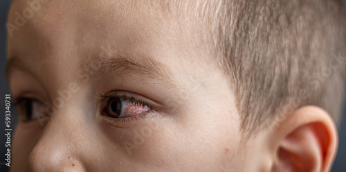 A young child with spoiled eyes suffers from conjunctivitis.Close up of a severe bloodshot eye.