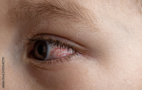 A young child with spoiled eyes suffers from conjunctivitis.Close up of a severe bloodshot eye.