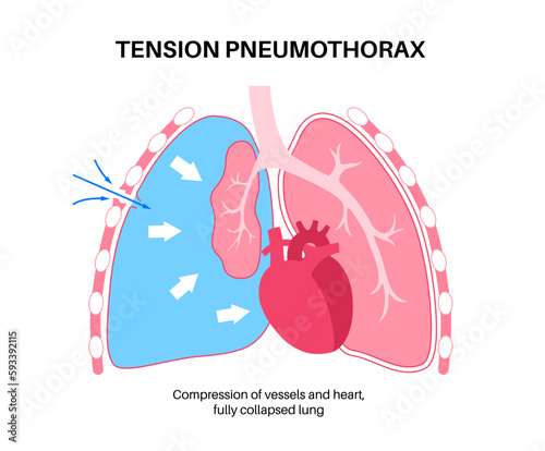 Tension pneumothorax poster