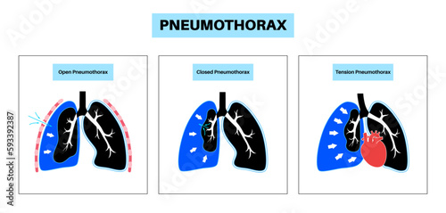 Pneumothorax anatomical poster