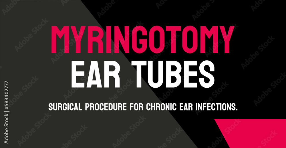 Myringotomy Ear Tubes Surgical procedure to insert tubes in the ears