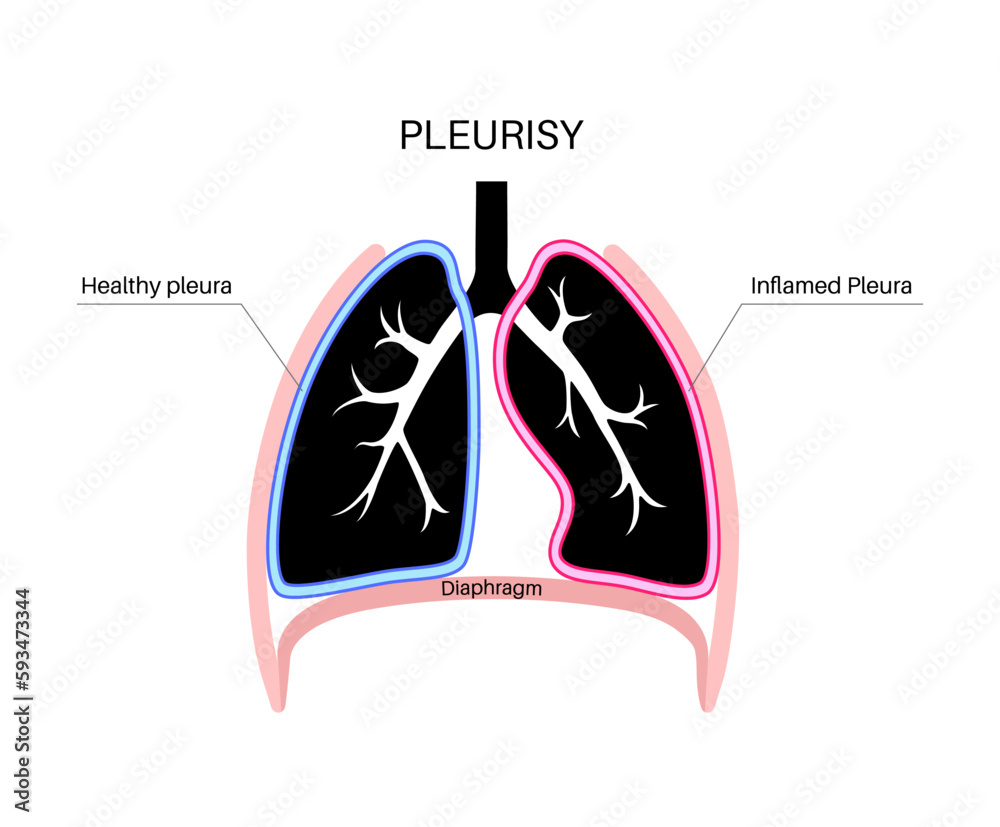Pleurisy inflammation diseases Pleurisy inflammation diseases