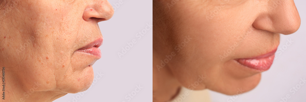 Obraz premium Woman before and after rejuvenating procedures. Collage with photos on white background, closeup