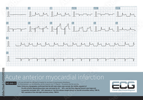 Photos A 69 year old patient with acute myocardial infarction, whose infarction affected the anterior wall, high lateral wall, and inferior wall, ultimately died during hospitalization