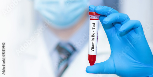 Doctor holding a test blood sample tube with Vitamin B6 test.