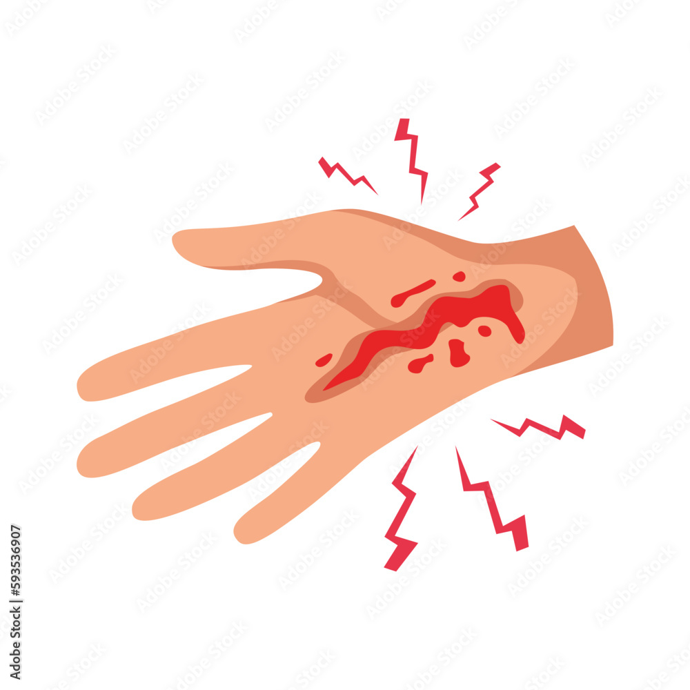 Fototapeta premium Flat Hand Injury