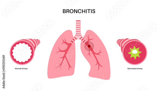 Bronchitis lung disease