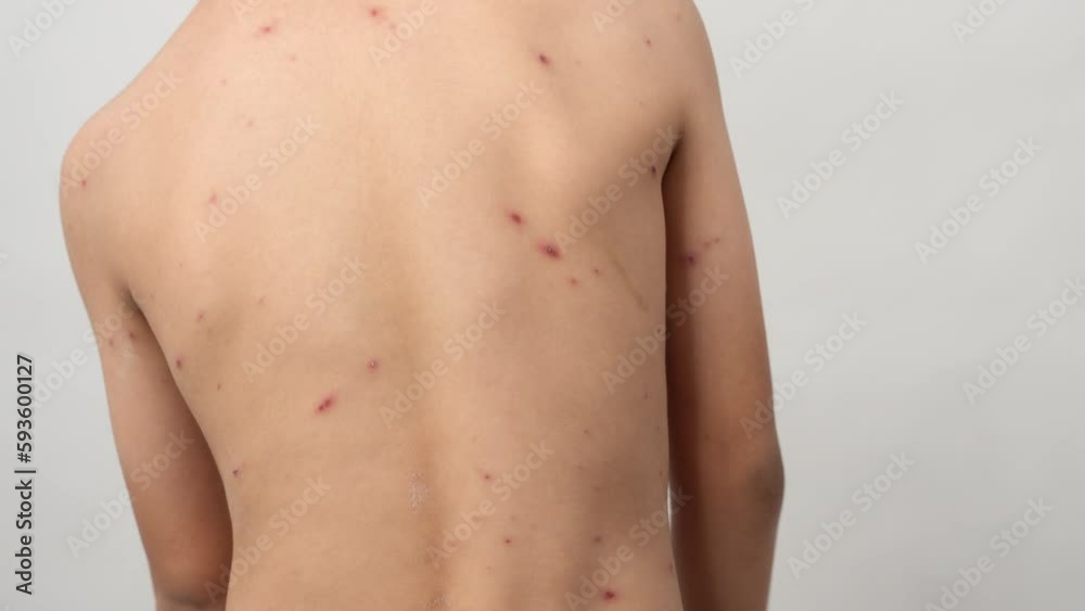 A 7 year old Asian boy has chickenpox. pimples on the body of child with chickenpox A 7 year old Asian boy has chickenpox. pimples on the body of child with chickenpox