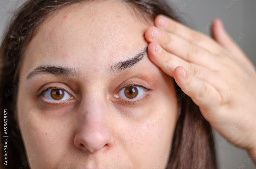 close up on white female face with some acne and dark circles, no make up close up on white female face with some acne and dark circles, no make up