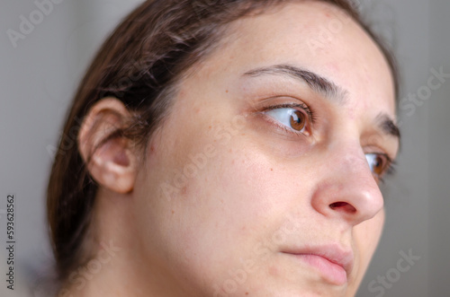 close up on white female face with some acne and dark circles  no make up