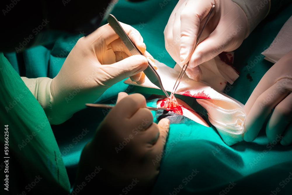 Close-up of the hands of a surgeon operating on a dermatological lesion, a fibroid. Close-up of the hands of a surgeon operating on a dermatological lesion, a fibroid.