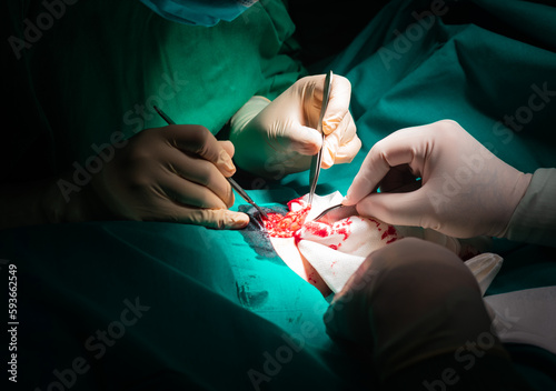 Close-up of the hands of a surgeon operating on a dermatological lesion, a fibroid.