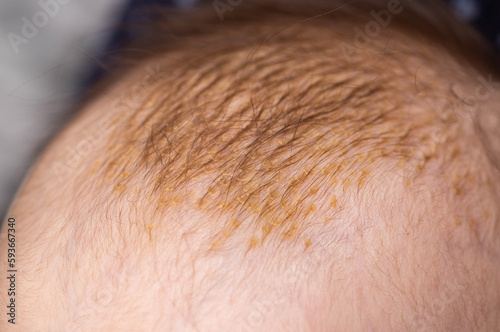 Milk crusts on the head of a newborn child, gneiss. The formation of yellow-golden scales on the head of an infant, close-up