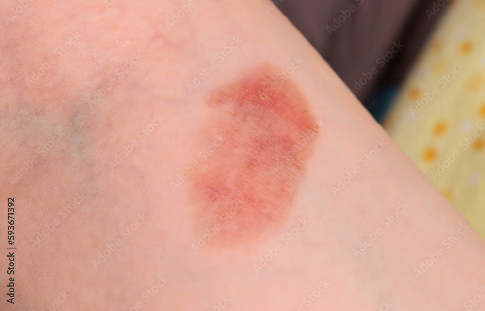 Red spot on the skin, skin damage from a burn on the arm. Close-up Red spot on the skin, skin damage from a burn on the arm. Close-up