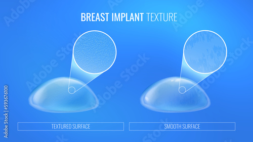 Breast implant surface types in infographics for plastic surgery in realistic style. Illustration comparing breast prostheses with different external textures. Vector with light effects