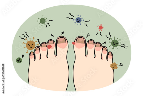 Person feet with nail disease or infection. Foot with onychomycosis or fungus on fingers. Medical treatment and procedure. Healthcare and medicine concept. Flat vector illustration. photo